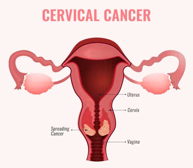 Cervical Cancer