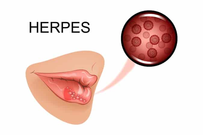 Herpes